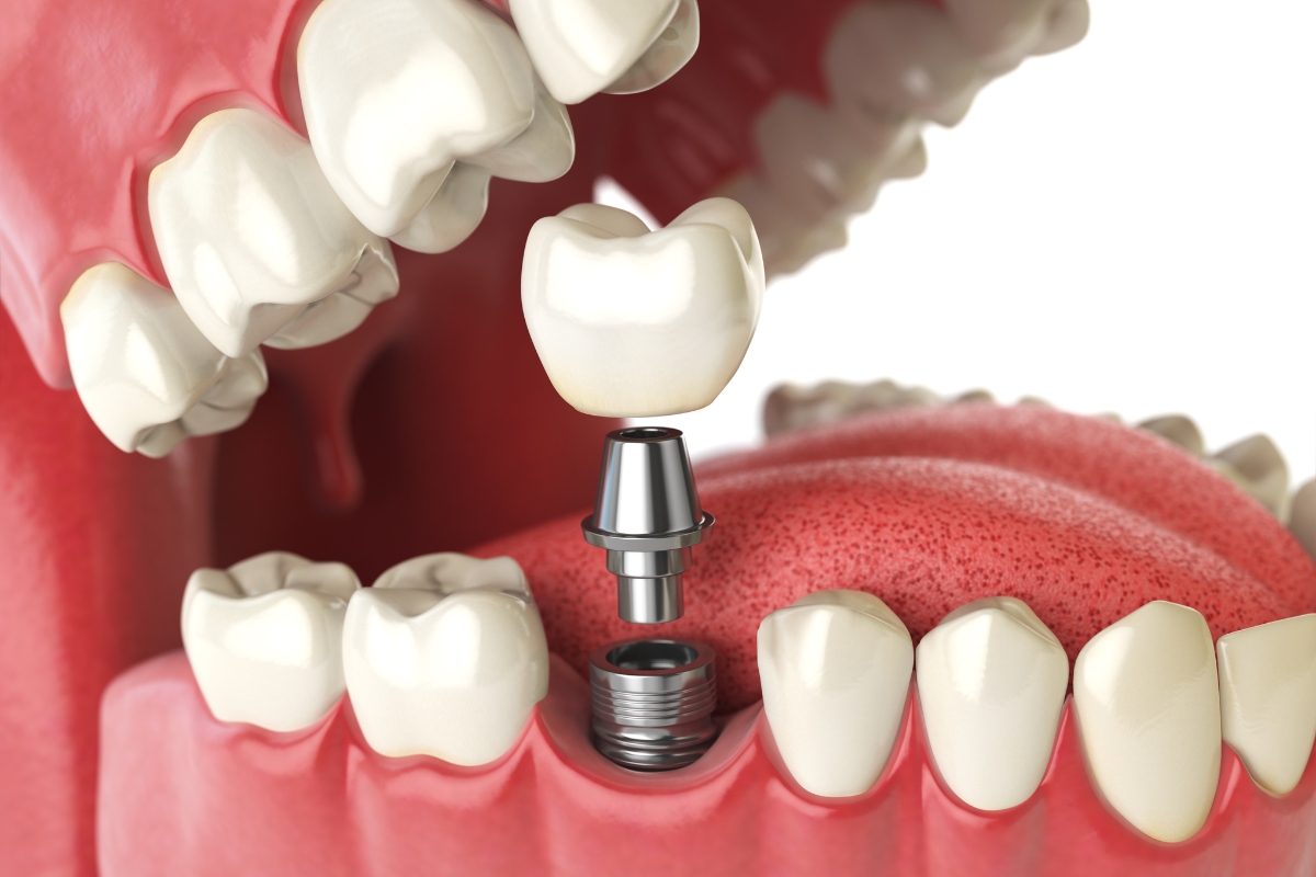 dental implants in Rockaway