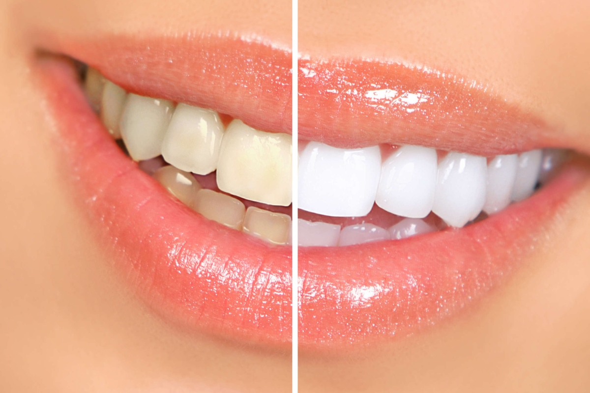 teeth whitening in Rockaway