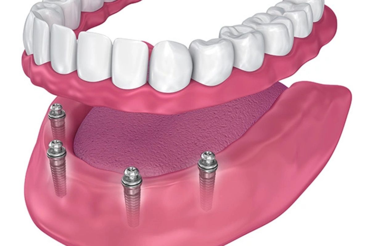 all-on-4 implants