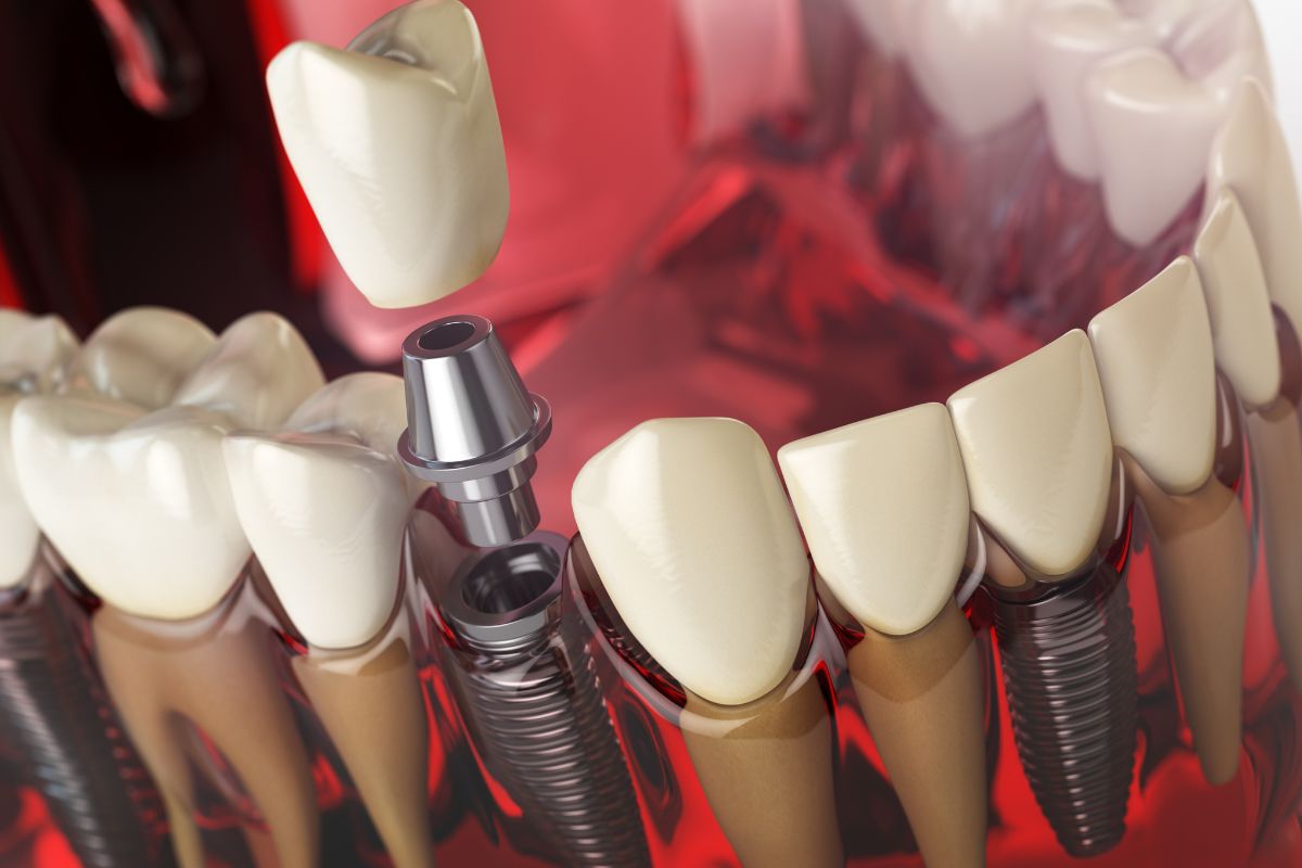 dental implant recovery timeline