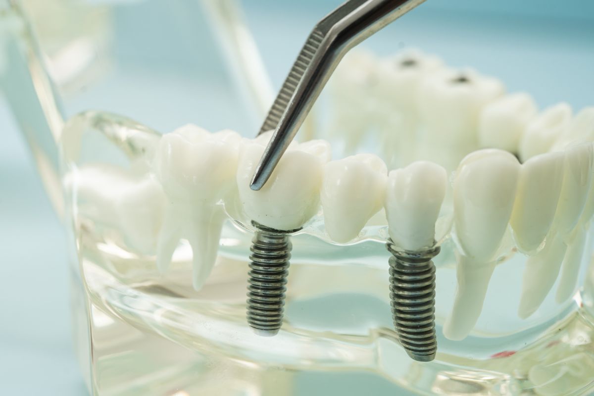 durability of all-on-4 dental implants