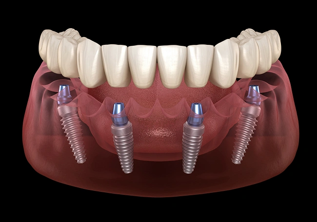all on-4 implants in rockaway, nj