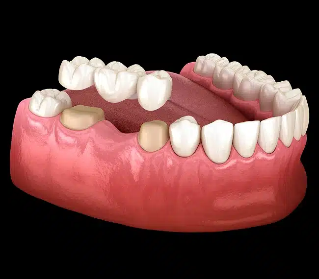 dental bridges in rockaway