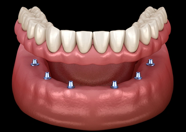 dentures, partials and mini implants in rockaway, nj
