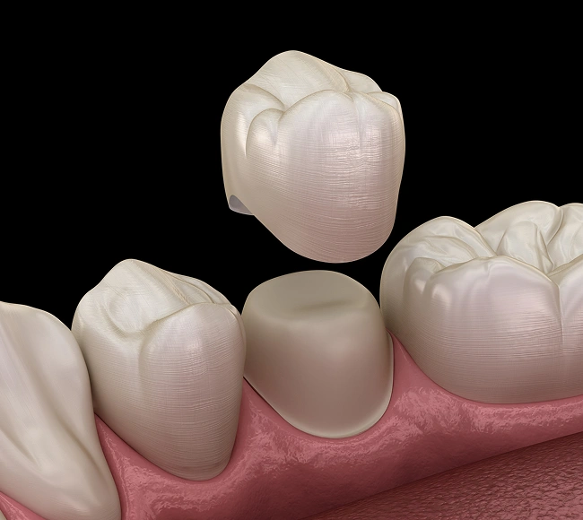porcelain crowns in rockaway