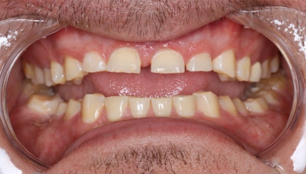 Tooth Extraction in Dover